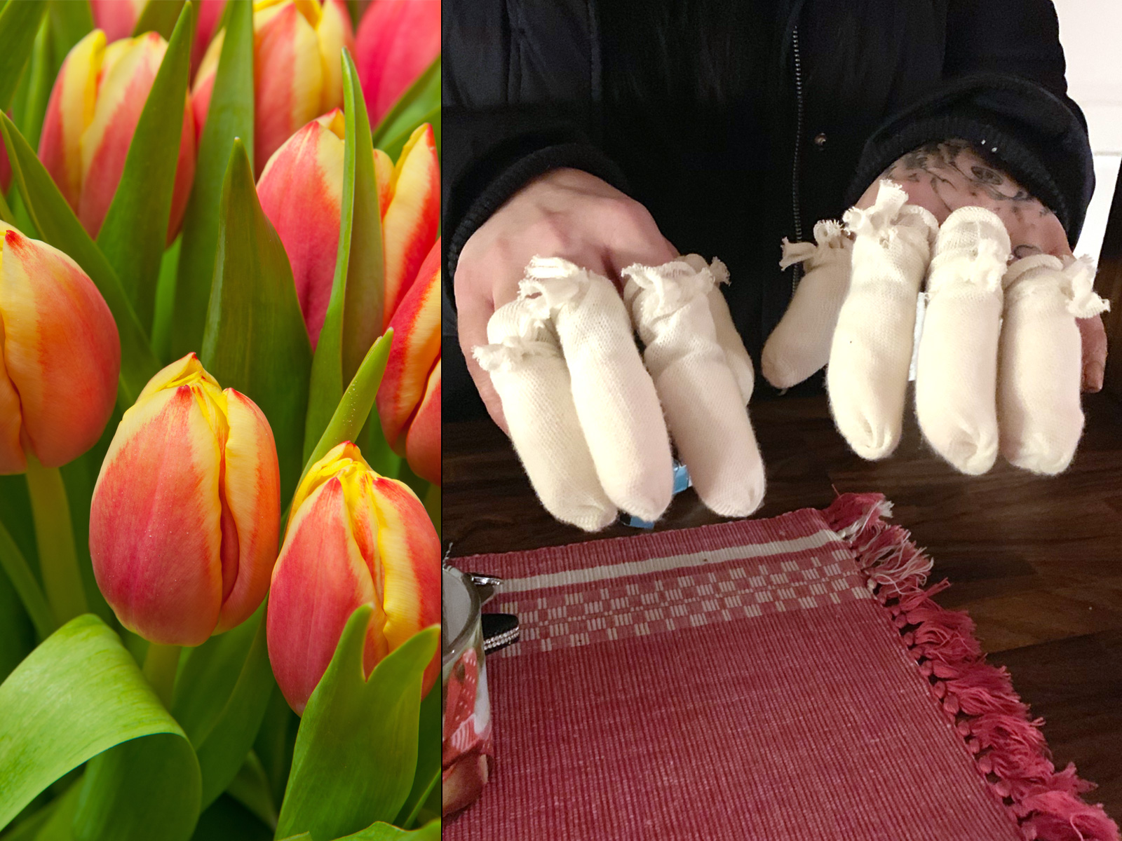 Marias händer efter frätskadorna.