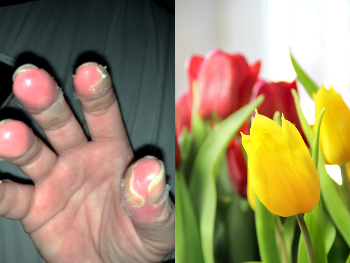 Maria fick frätskador på fingertopparna.