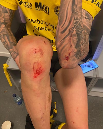 Skador på Mjällbys spelare efter match mot Hammarby på Tele2 Arena.