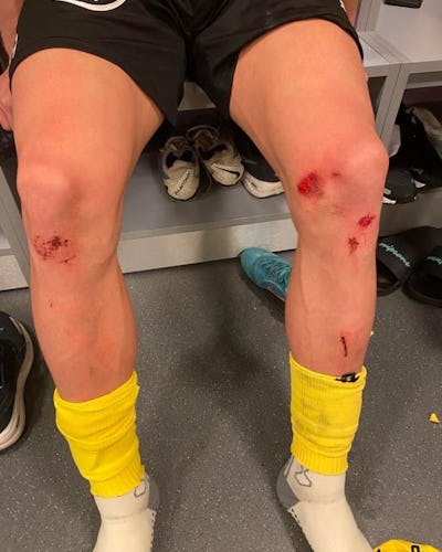 Skador på Mjällbys spelare efter match mot Hammarby på Tele2 Arena.