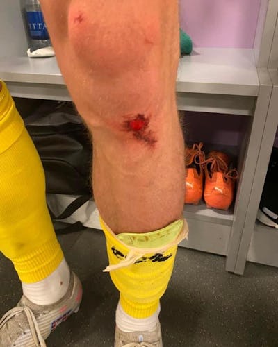 Skador på Mjällbys spelare efter match mot Hammarby på Tele2 Arena.