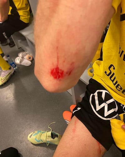 Skador på Mjällbys spelare efter match mot Hammarby på Tele2 Arena.