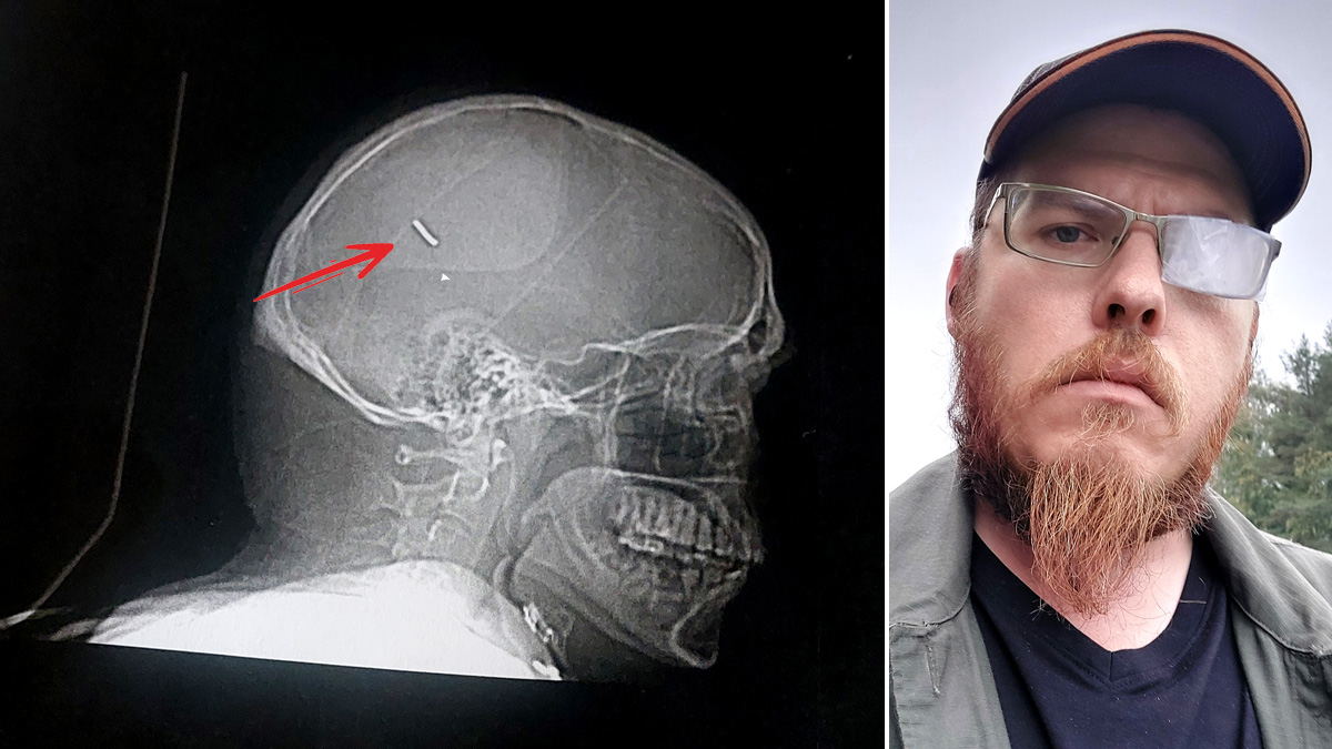 En metallbit slungades in genom Michael Wiinikkas öga och vägarbetaren var nära att dö.