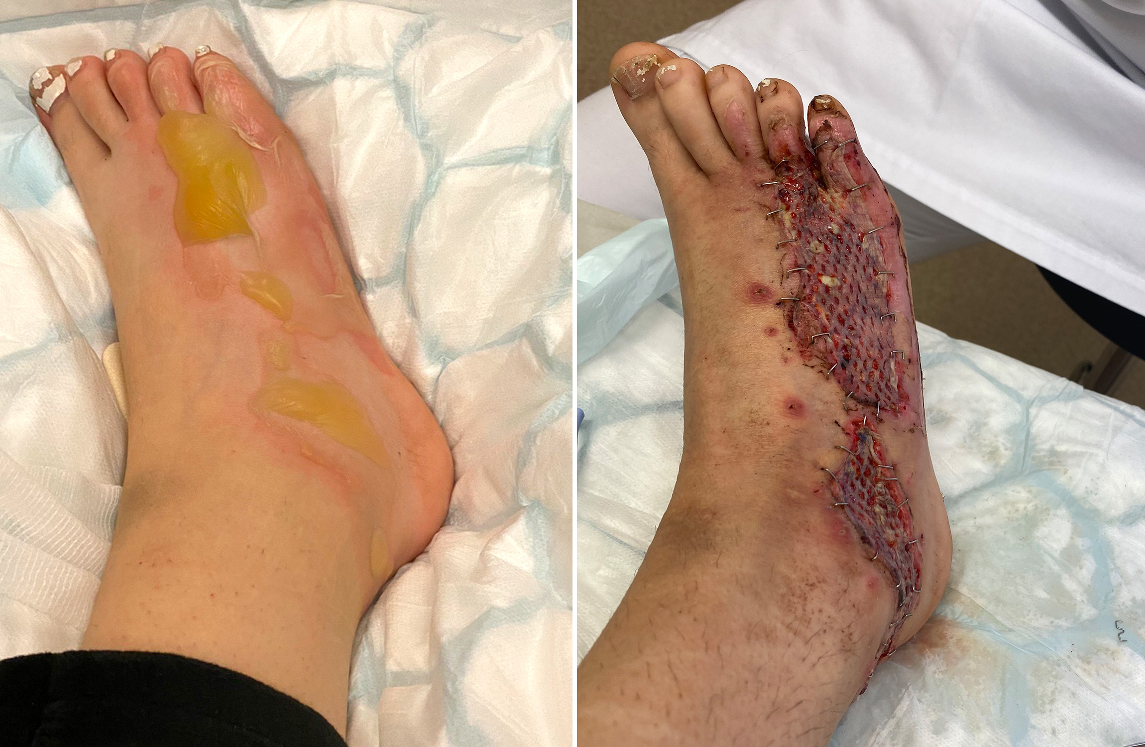 Brännskadade fötter.