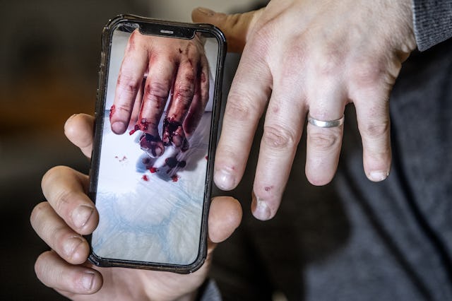 Mattias händer håller i en mobiltelefon med en blodig bild på hans hand efter olyckan.