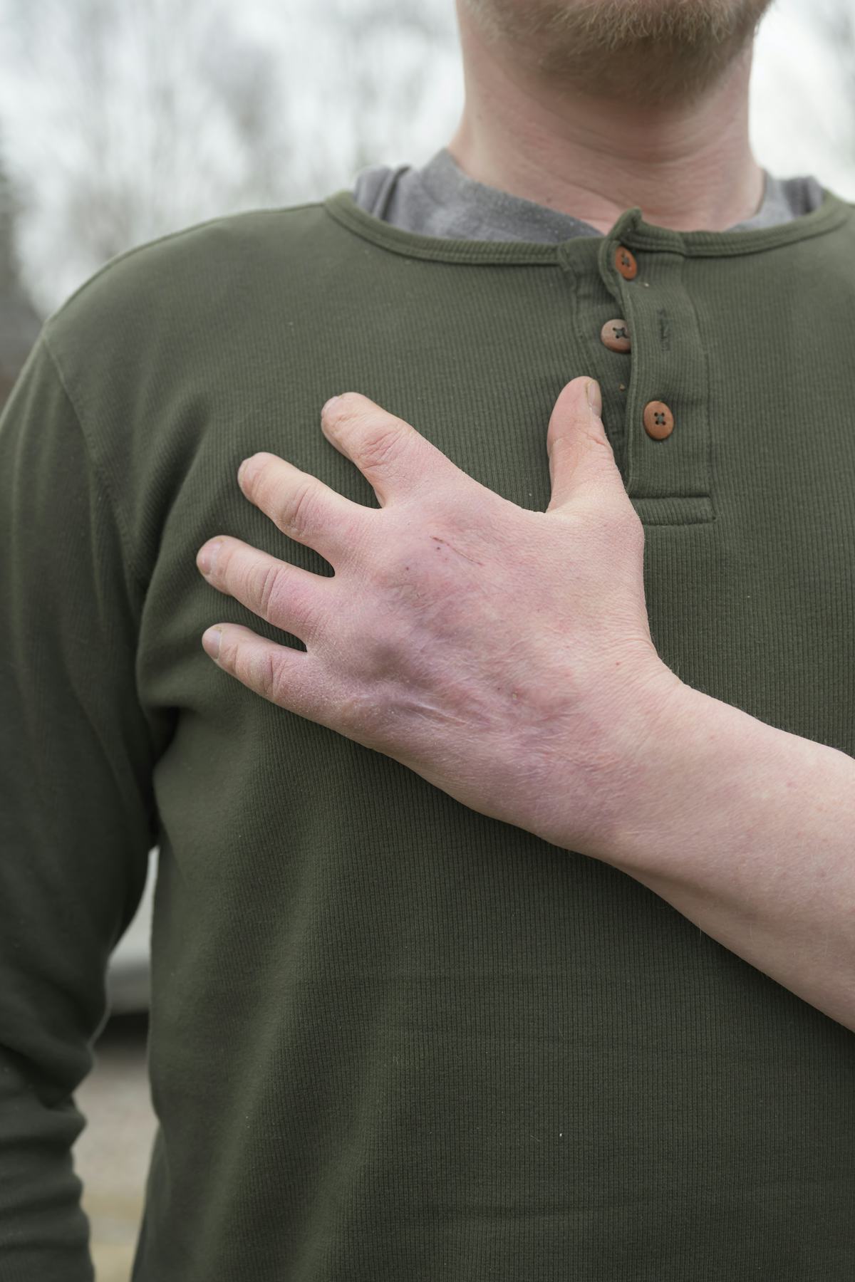 Markus Hed i en grön långärmad tröja håller sin högra hand mot bröstet utomhus. Yttersta topparna på flera fingrar saknas.