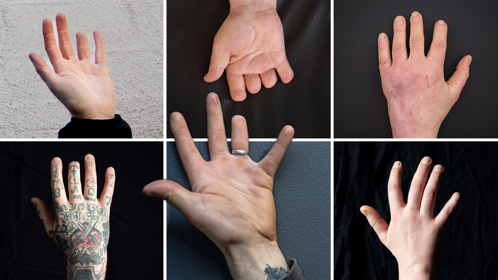 Sex händer i olika positioner och vinklar. Gemensamt för alla är att delar av ett eller flera fingrar saknas.