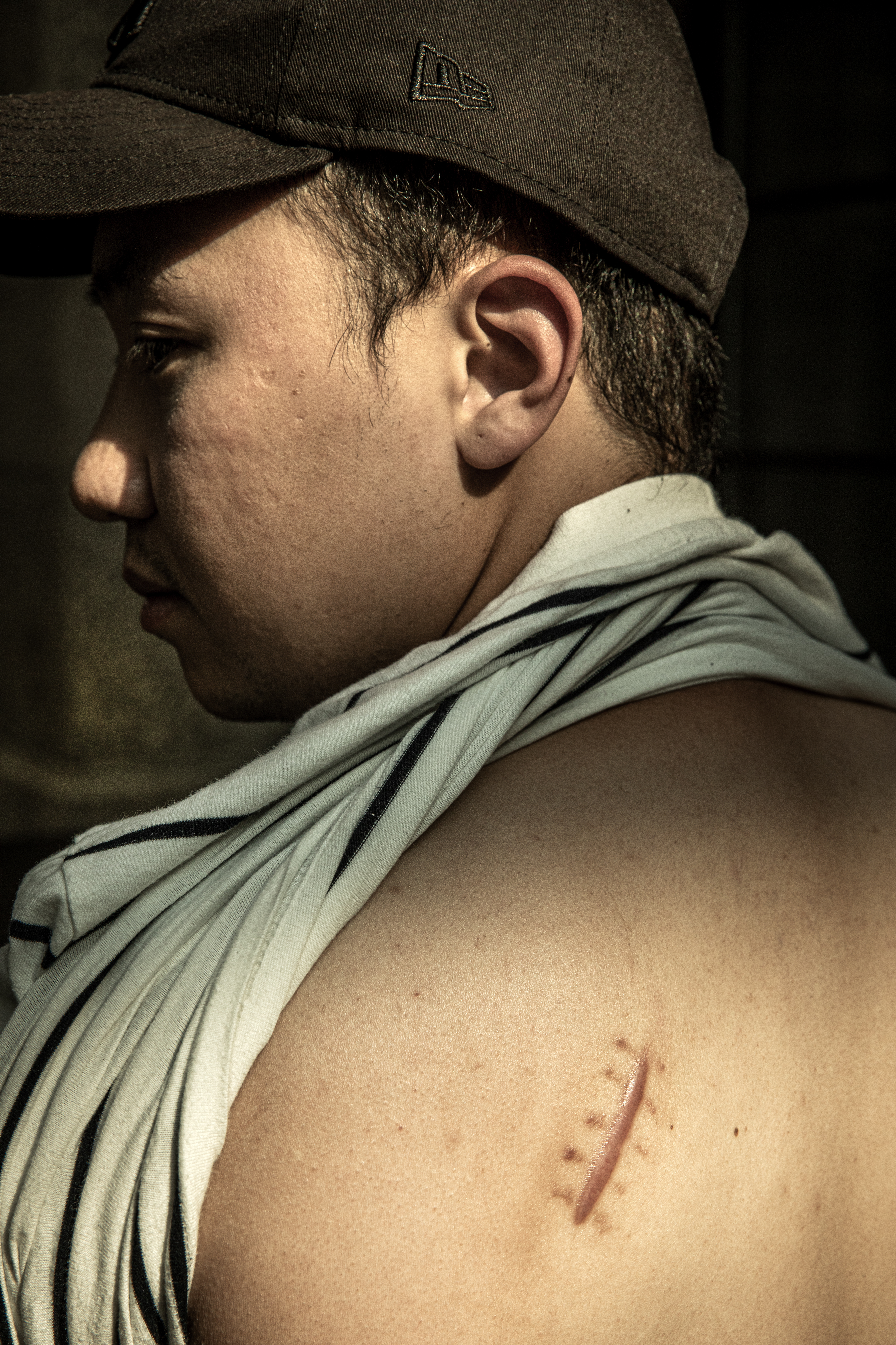 Le Loc Nguyen med keps vänder sig bort från kameran och visar ett ärr med stygn på övre delen av ryggen och axeln.