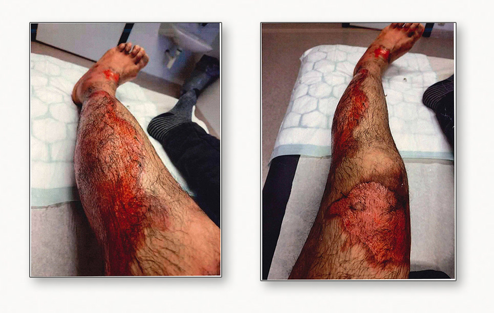 Brändskadade ben efter stekbordet.