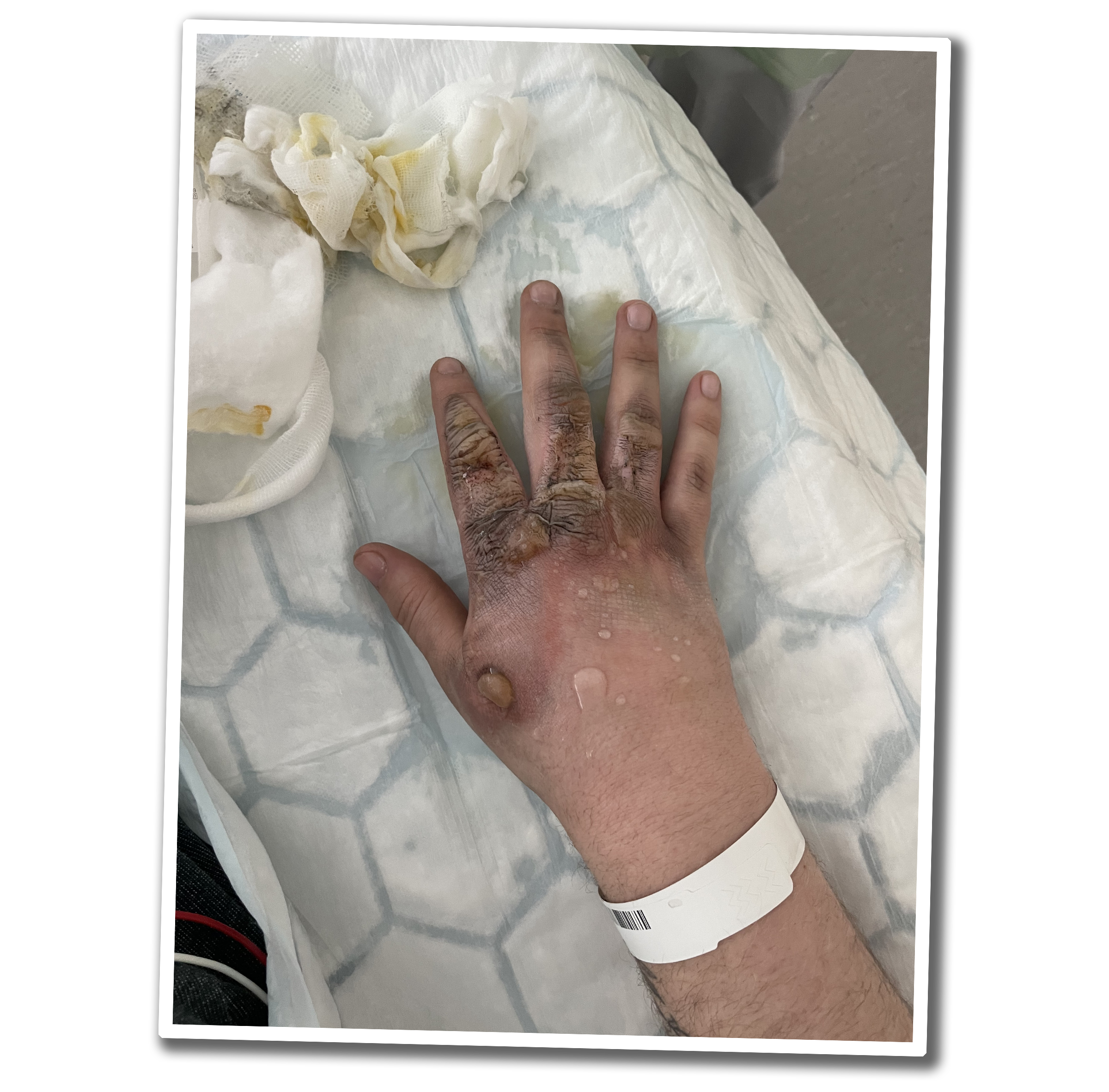 En hand med blåsor, missfärgningar och bandagerad handled vilar på en sjukhussäng; medicinsk gasbinda och papper ligger intill.