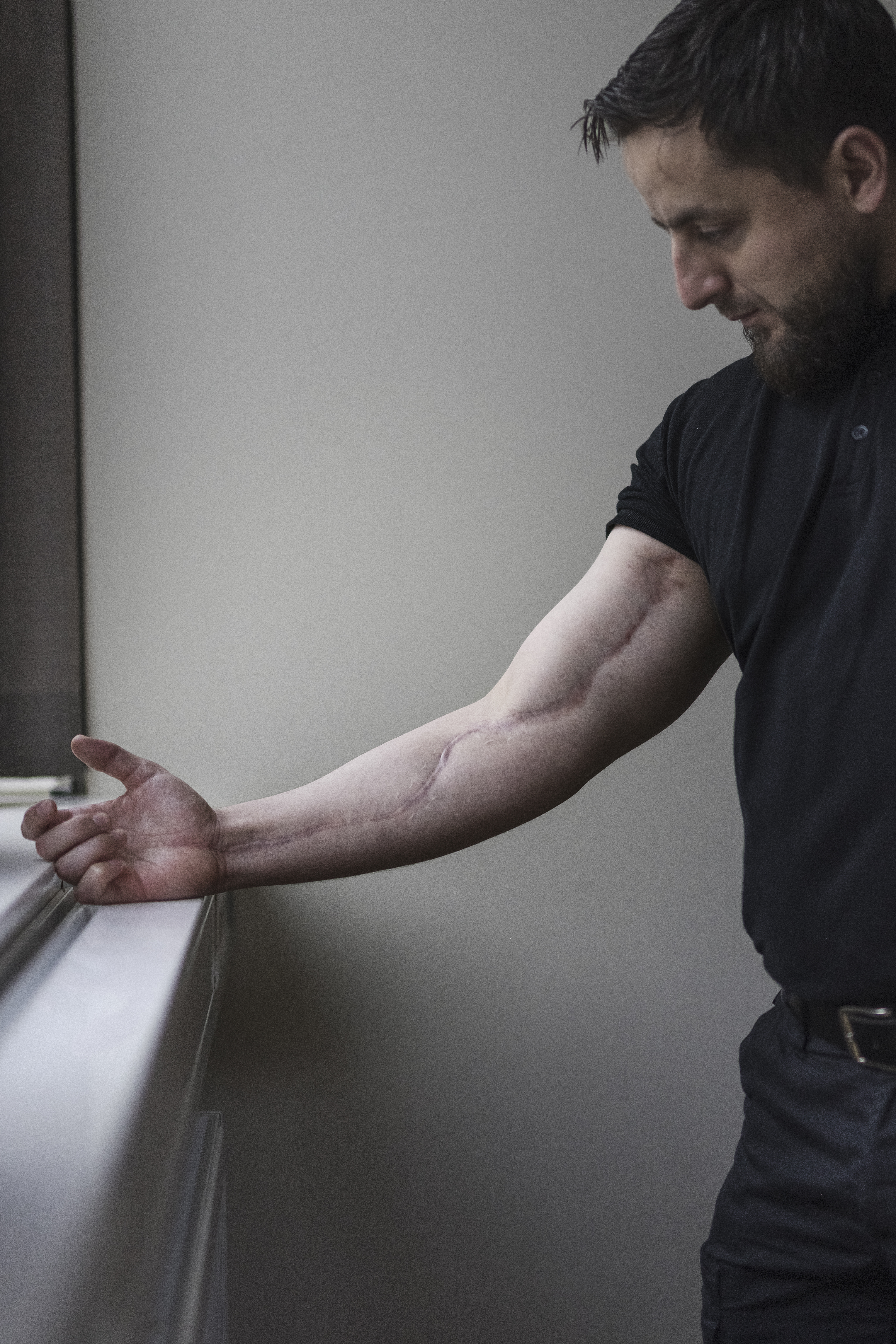 En man i svart skjorta står vid ett fönster och tittar ner på sin utsträckta arm som har ett långt ärr hela vägen till armhålan.