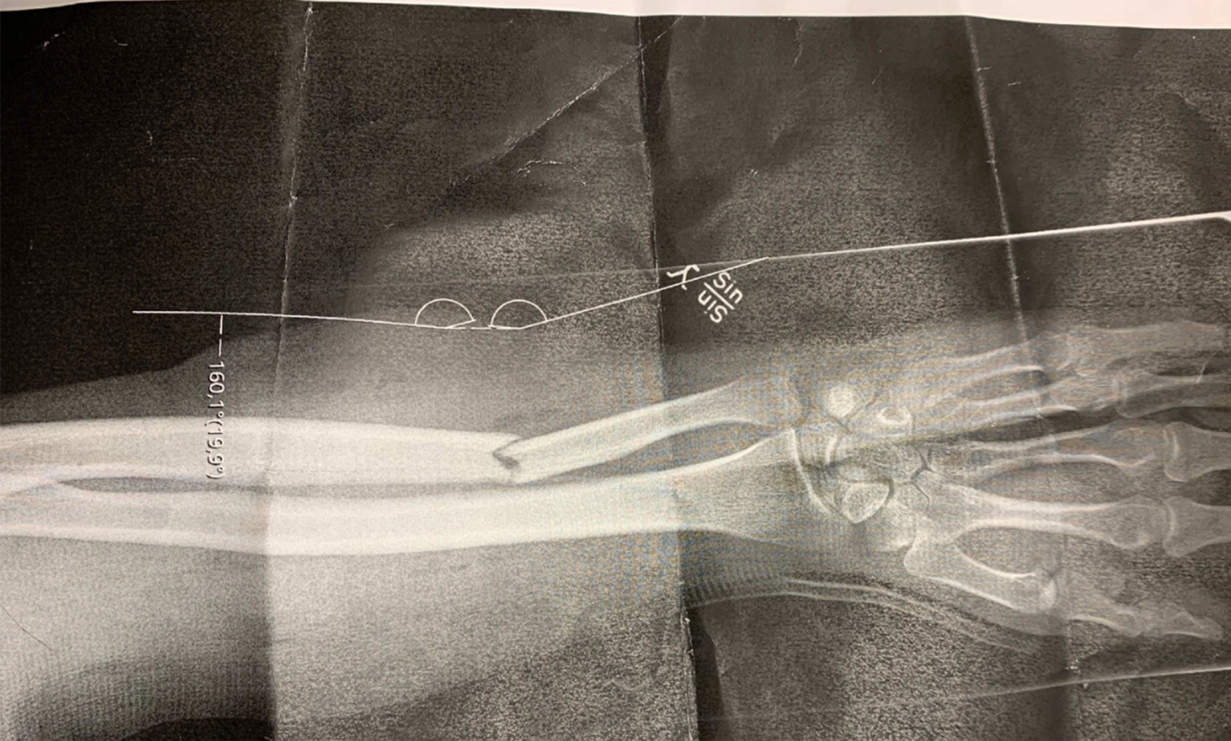 Röntgenbild på 35-åringens brutna arm.