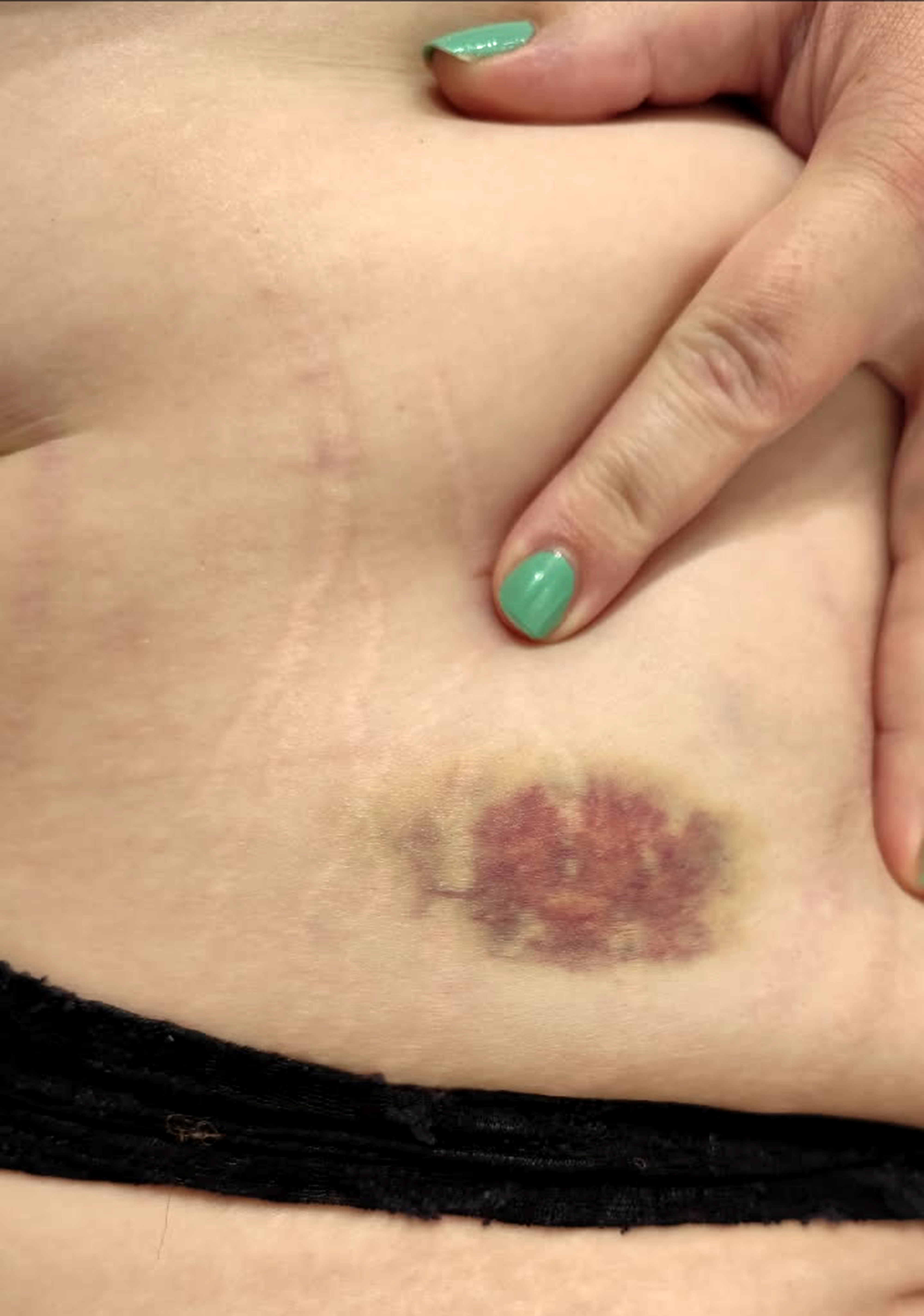 Närbild av en persons sida som visar ett blåmärke vid midjan, och en hand pekar på blåmärket.