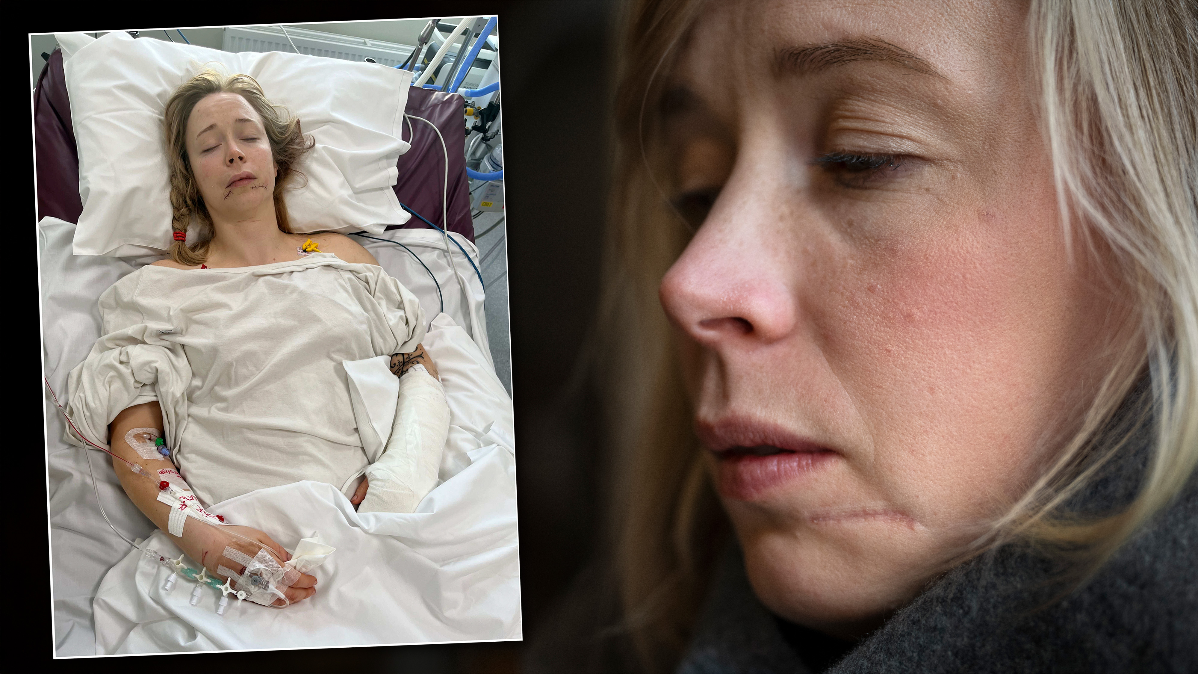En kvinna med gips och dropp ligger i en sjukhussäng; en närbild visar hennes ansikte och ett ärr på hennes läpp.