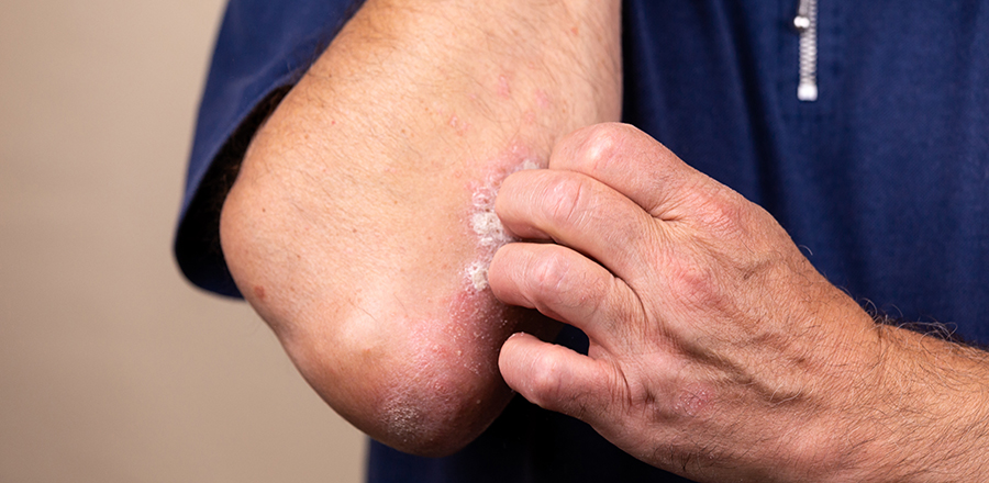 Bilden visar ett eksem vid en mans armbåge.