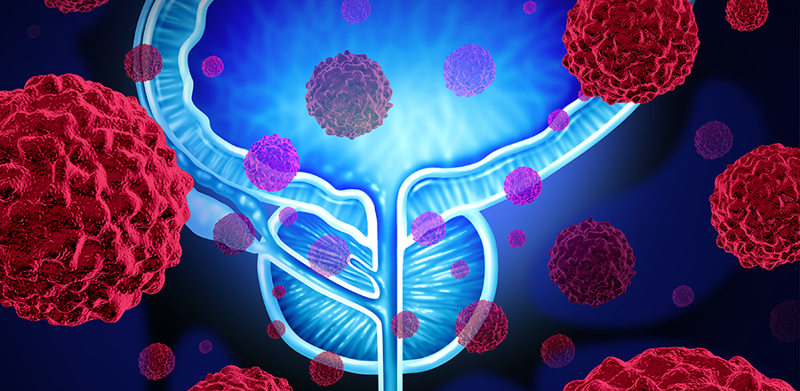 Illustrationen föreställer prostatacancer.