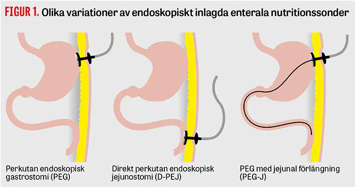 Perkutan endoskopisk gastrostomi – nya nationella rekommendationer ...