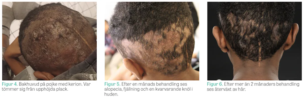 Barbiedrogen melanotan – ny nätdrog med riskabla följder – Läkartidningen Barbiedrogen melanotan – ny nätdrog med riskabla följder – Läkartidningen