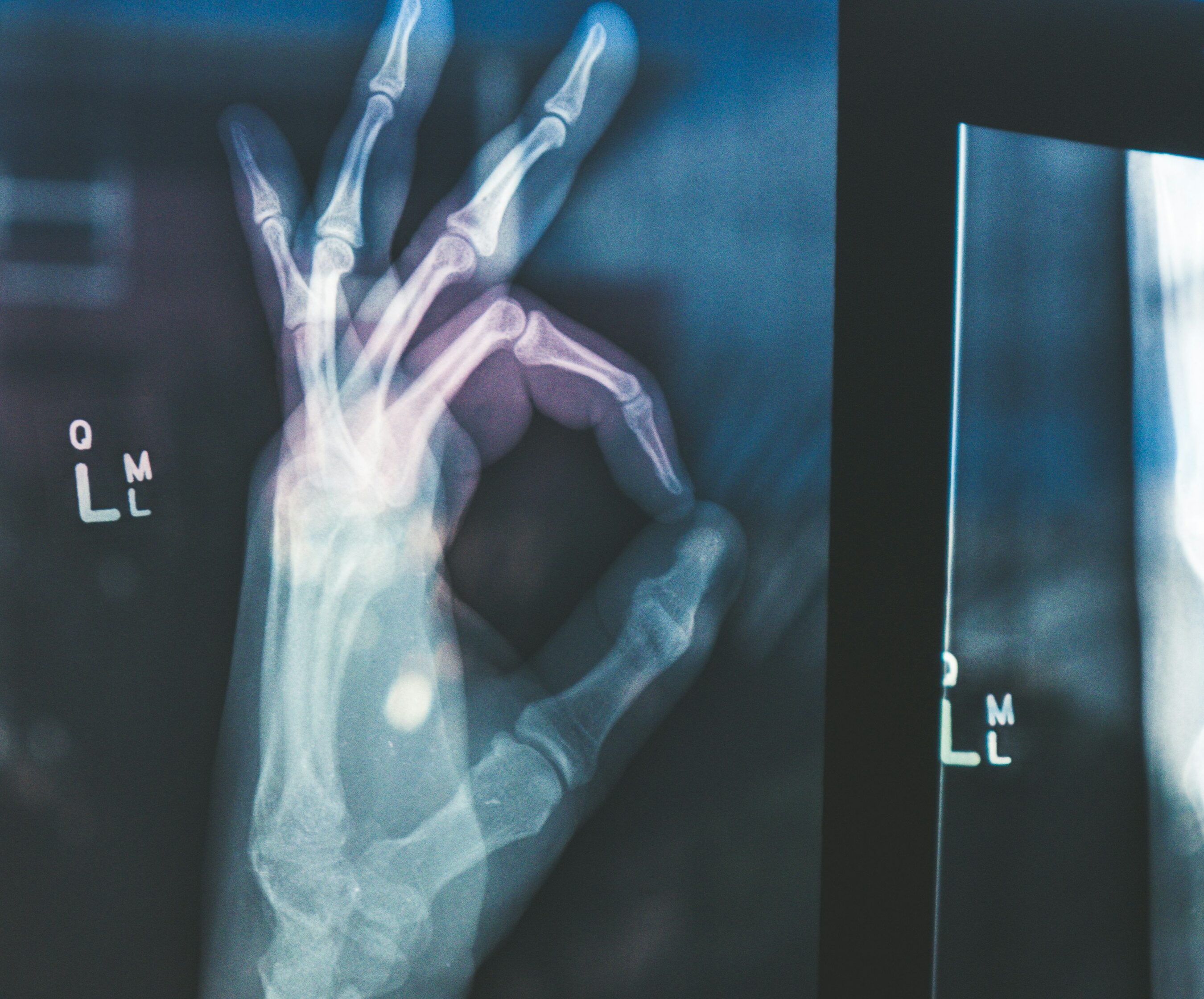 Röntgenbild av en hand som gör ett "OK"-tecken, där skelett och leder syns tydligt.
